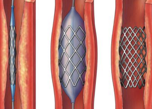 好消息！700元冠脈支架來(lái)了帶量采購(gòu)結(jié)果在甘肅省正式落地執(zhí)行